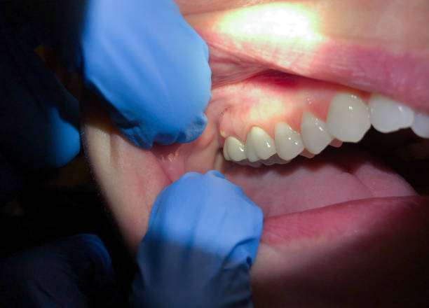 Best Knocked-Out Tooth (Avulsed Tooth) Treatment in Granite Falls, MN